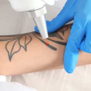 Tattoo Removal