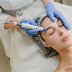 Melasma Treatment (PICO Laser) (60 min)